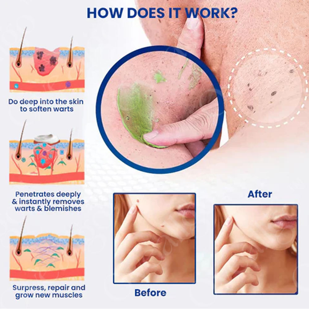 ✅ Official Store: Oveallgo® NatureErase Instant Alligator Oil Mole & Spot Removal Premium Gel