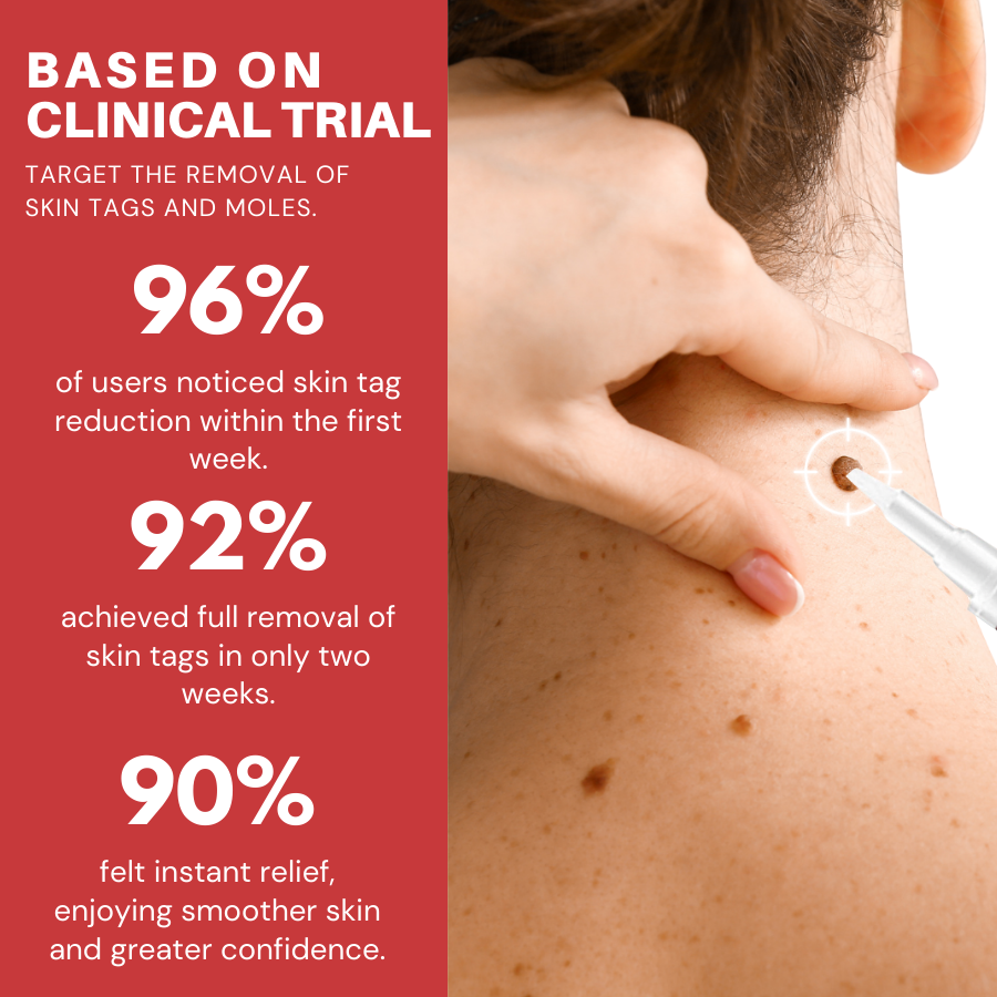 Fivfivgo® Tags & Moles Remover Pen