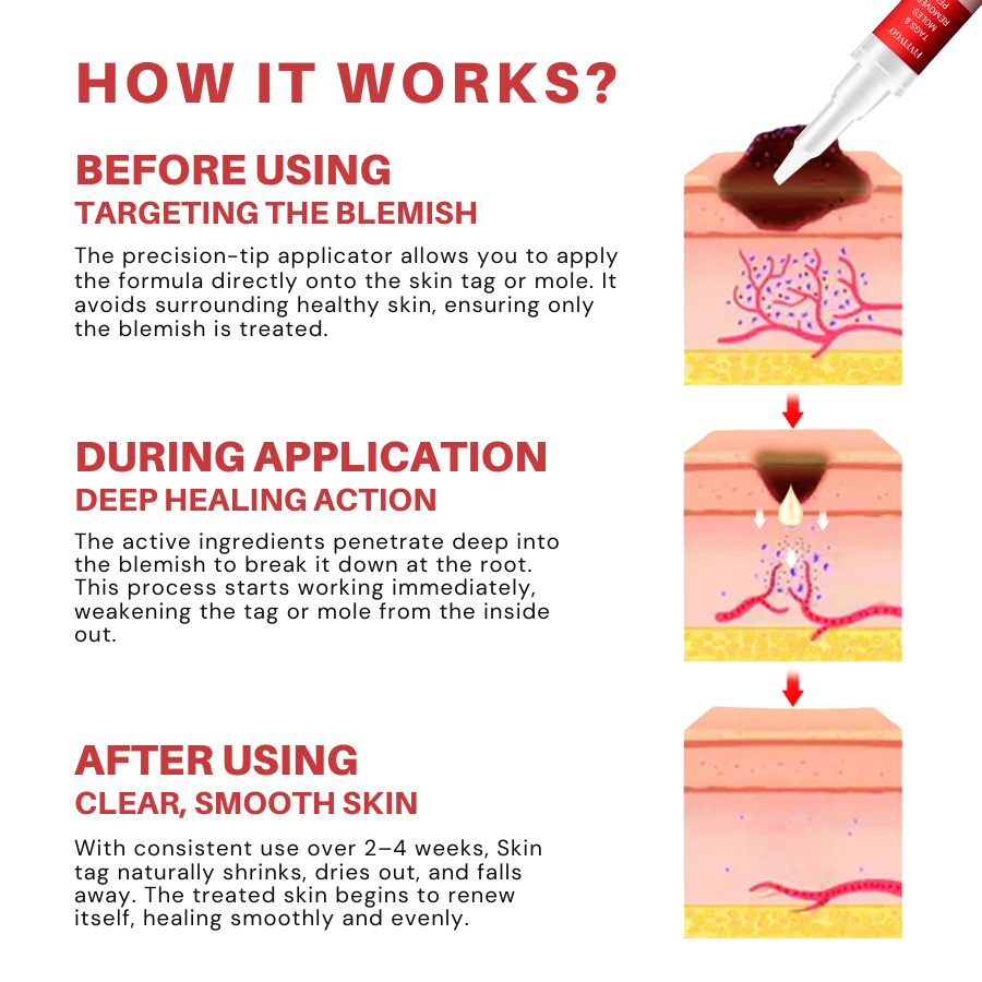 Fivfivgo® Tags & Moles Remover Pen