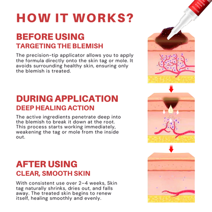 Fivfivgo® Tags & Moles Remover Pen